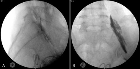 Image result for Selective Nerve Root Block vs Transforaminal