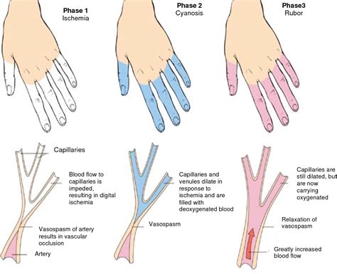 Treatment For Raynaud's Phenomenon