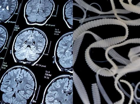 Brain Tapeworm