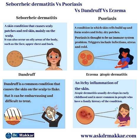 Dandruff Vs Seborrheic Dermatitis