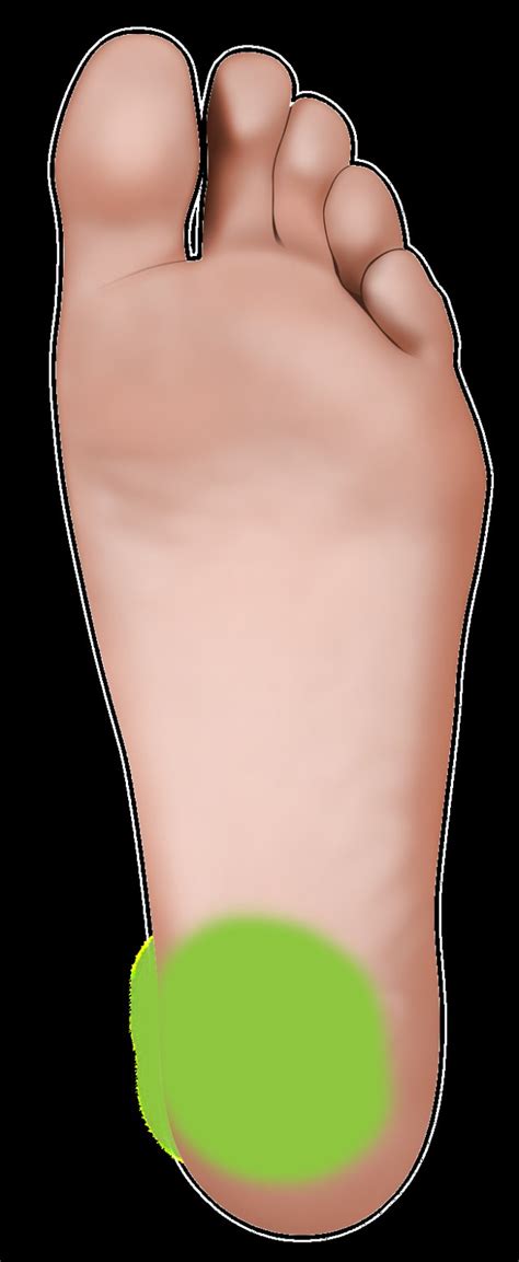 Plantar Fasciitis 的图像结果