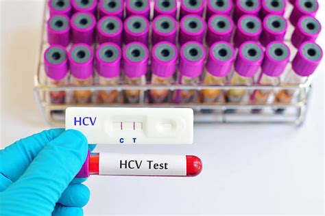 Hep C Test 的图像结果