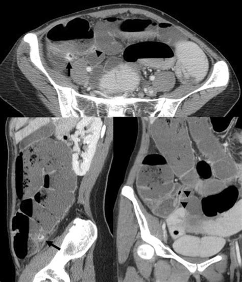 Image result for Colonic Diverticulum CT