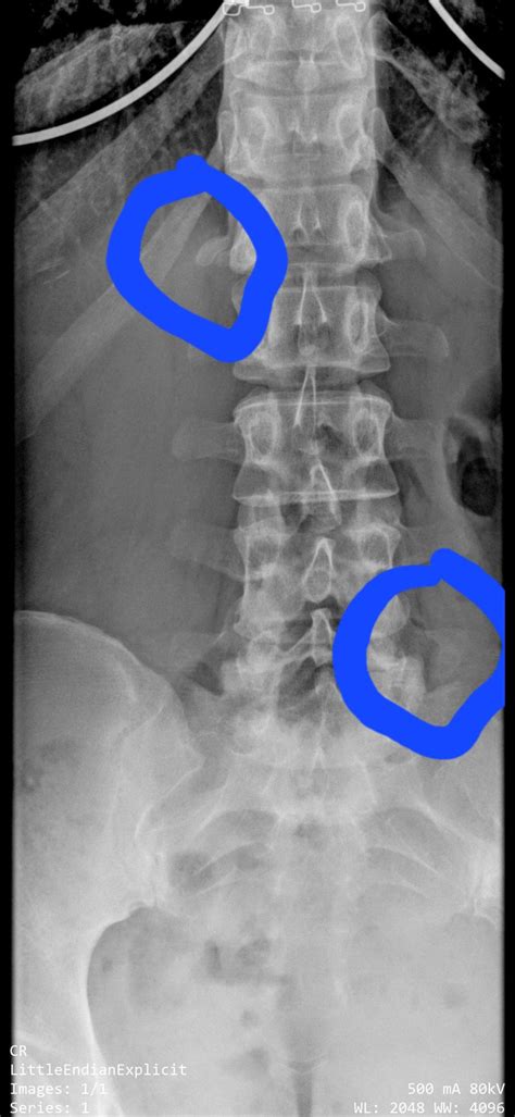 Cervical Transverse Process Fracture