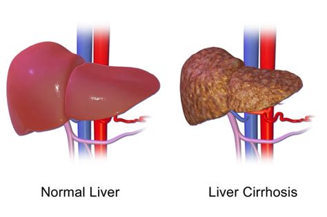 Sirosis Hepatis - patofisiologi, diagnosis, penatalaksanaan - Alomedika