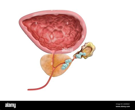 Stage III prostate cancer. Illustration of part of the male reproductive system in vertical ...