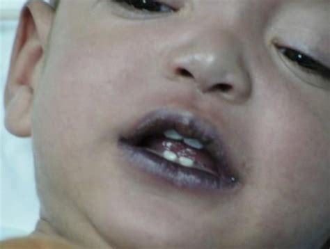 ACYANOTIC HEART DISEASE