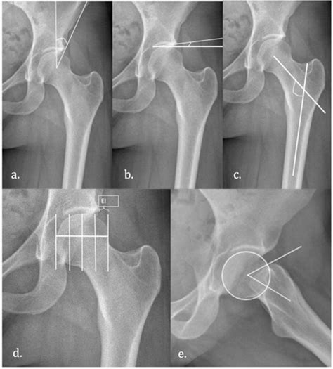 Hip Preservation Surgery in Osteoarthritis Prevention: Potential ...
