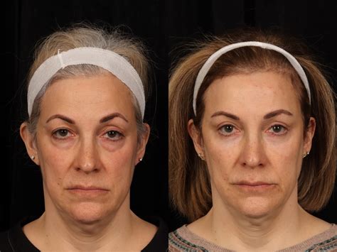 Mid Facelift Before & After Photos | W Cosmetic Surgery