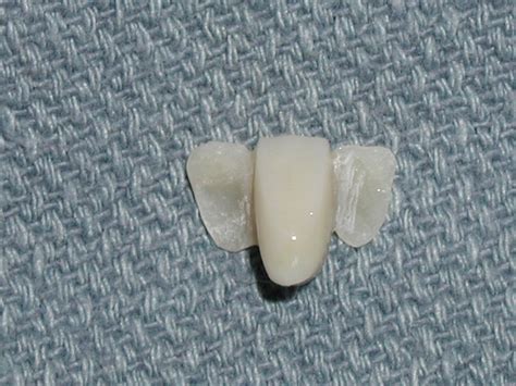 Maryland Bridge Archives - Dr. Paul Caputo Comprehensive Dentist Palm Harbor | Gesundheit