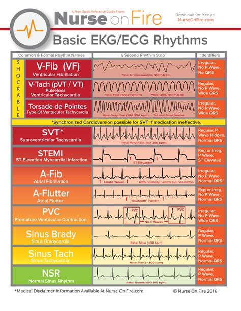 Basic EKG Rhythms - EKG - Basic EKG/ECG Rhythms V-Fib (VF) V-Tach (pVT / VT) Torsade de Pointes ...