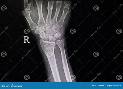 Xray Film of Fracture Wrist Bones Stock Image - Image of operation ...