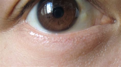 眼睛白眼球上有白点眼睛白眼球上有白点图片2022已更新今日更新