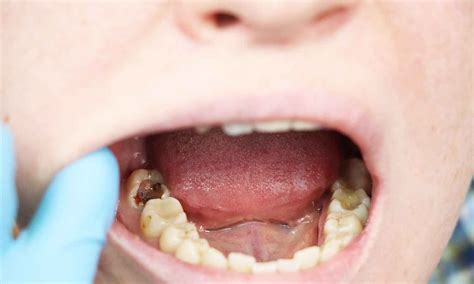 LumiCare and BlueCheck effective for Early Detection of Caries ...