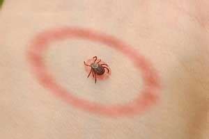 Latest NICE Guidelines on Lyme Disease