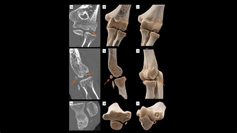 Osteochondritis dissecans of the capitellum - Siemens Healthineers