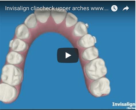 Image result for Invisalign ClinCheck