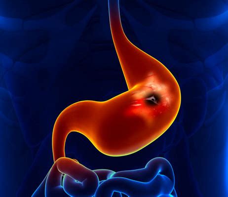 胃溃疡为什么那么难治愈，吃什么对胃溃疡痊愈有帮助呢？