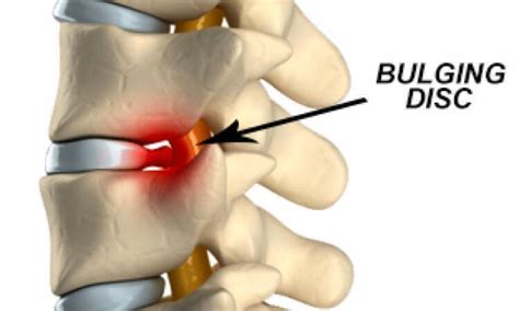 Types and Causes of Circumferential Disc Bulge