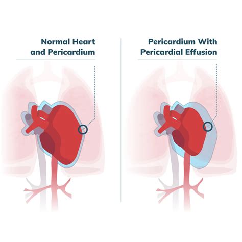 Pericardial Window Surgery | CTVSA of Jacksonville, FL