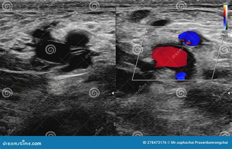 A Carotid Artery Doppler Ultrasound is a Diagnostic Test Used To Check ...