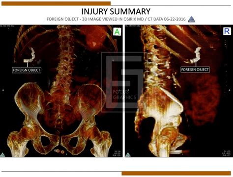 Image result for Retained Object Complement