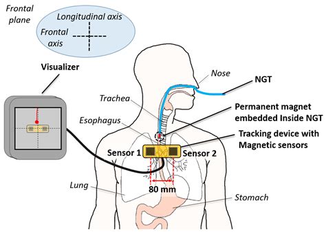 A Low-Cost, Point-of-Care Test for Confirmation of Nasogastric Tube ...