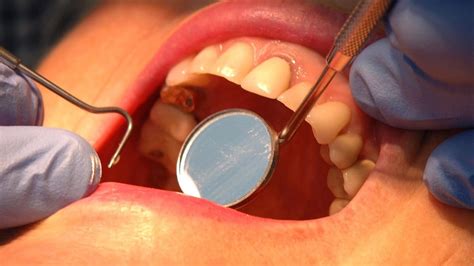Use of mercury-based dental fillings to be phased out – The Irish Times