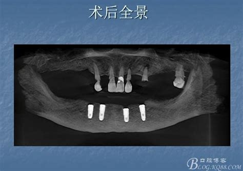 下颌四颗osstem种植体，杆卡联合Locator基台修复-牙医关鑫的博客-KQ88口腔博客