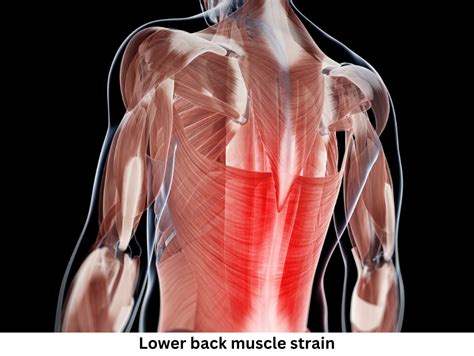 Image result for Left Lower Back Muscle Strain