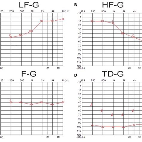 Audiogram Types and examples 的图像结果