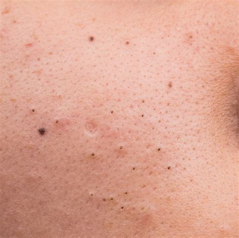 What Do Blackheads Look Like On Nose at Holly Brough blog