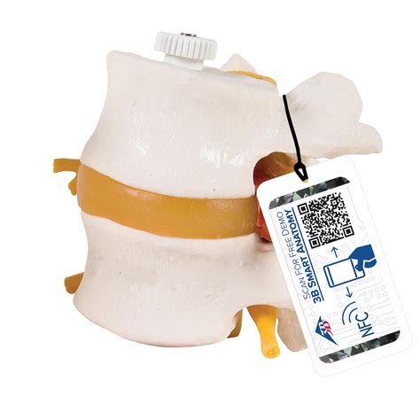Buy 3B Scientific A76/9 2 Lumbar Vertebrae w/Prolapsed Disc Flexible ...