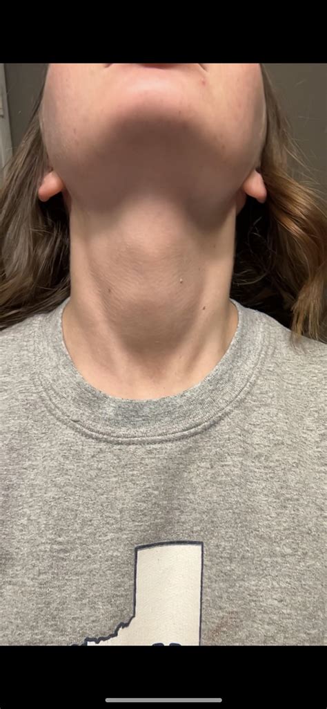 Prominent thyroid? Pics included : r/thyroidhealth