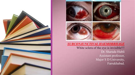 Subconjunctival Haemorrhage,causes,treatment..pptx