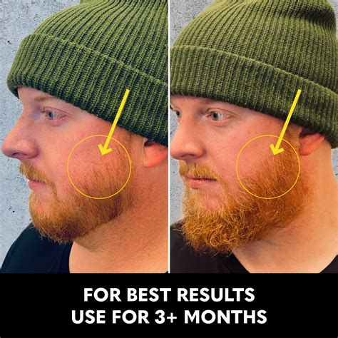 Derma Roller Beard Support Growth Kit - The Beard Club