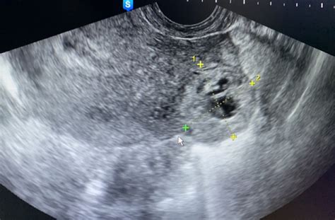 Cornual Interstitial Pregnancy