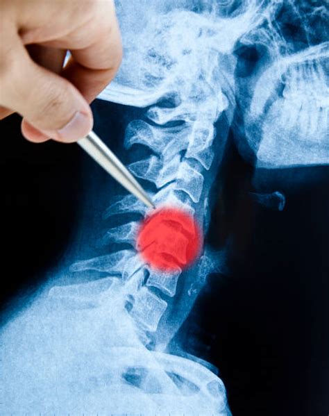 Image result for Neck X-Ray