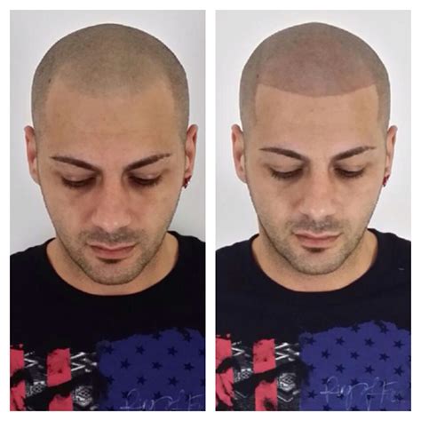 Before and after of an amazing procedure we did. We are the best in the art of hair tattoo and ...