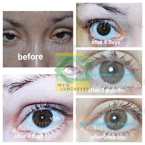 Image result for Eye Color Surgery