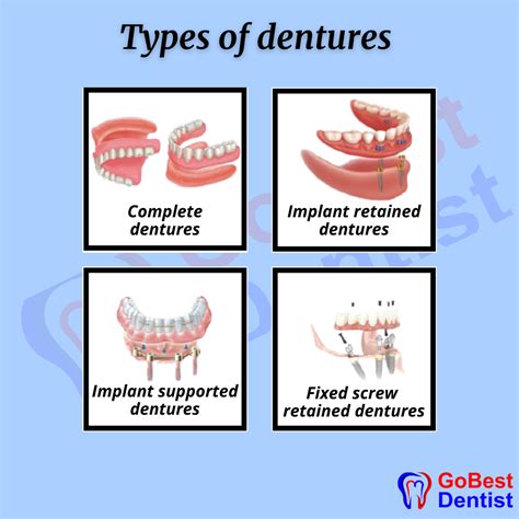 Flexible Partial & Complete Denture - Gobest Dentist