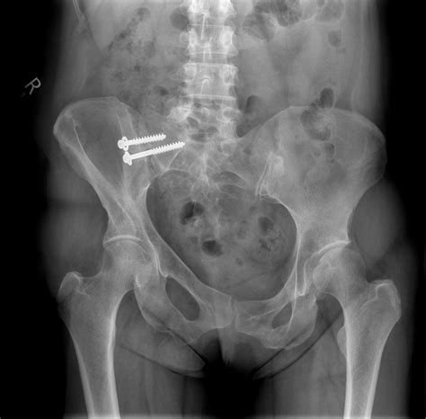 Sacroiliac Joint Fracture X Ray at Donald Pray blog