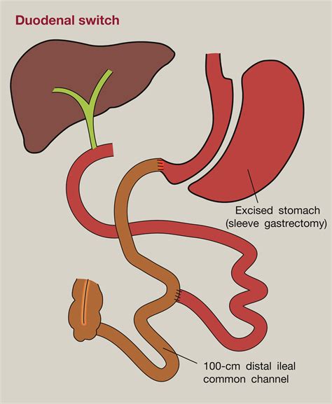 The management of bariatric surgery complications - Surgery - Oxford International Edition