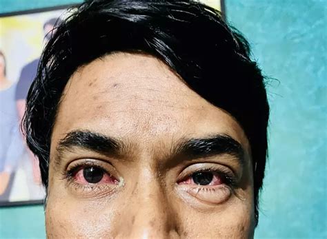 Conjunctivitis Spreading Rapidly In Arunachal: A Guide To Prevent This ...