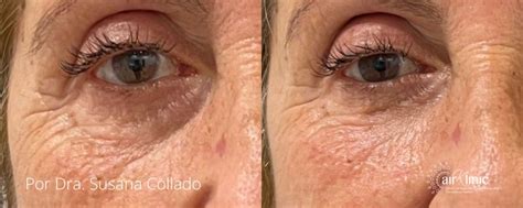 Tratamiento para las ojeras - Airklinic
