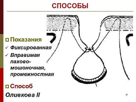 ГРЫЖИ И СПОСОБЫ ГРЫЖЕСЕЧЕНИЯ Лекция для студентов III