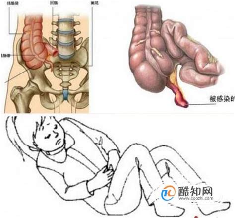阑尾在哪个位置_阑尾部位图_阑尾的位置_阑尾炎症状
