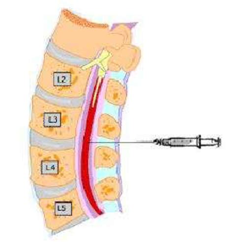 Image result for Spinal Injection Coding Videos