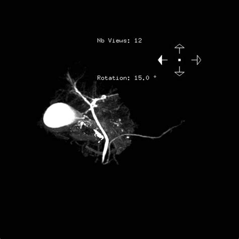 Image result for Abnormal MRCP