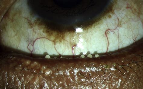 Meibomian Gland Disease - Ophthalmology